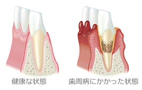 歯周病の状態