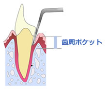 歯周ポケット