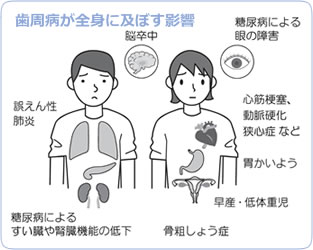 歯周病が全身に及ぼす影響