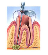 根管治療