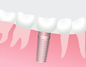 くれいし歯科インプラント