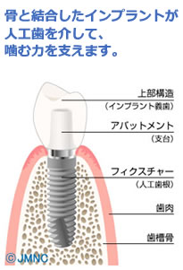 くれいし歯科インプラント