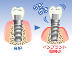 インプラント：治療後に大切なこと