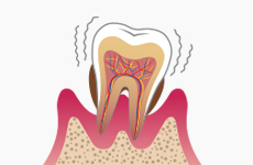 歯周病