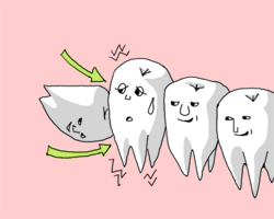歯の豆知識 第39回 親知らずの対処法 歯の豆知識 岡山市のくれいし歯科クリニック