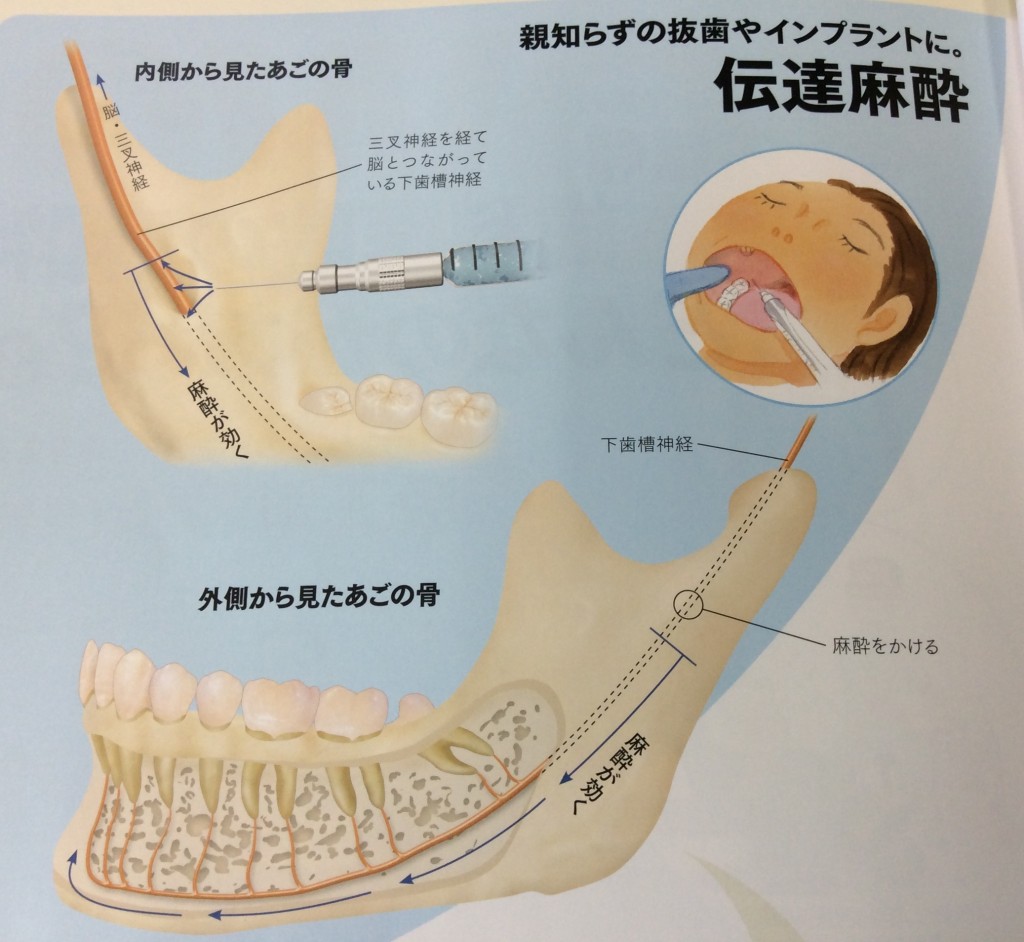 伝達麻酔