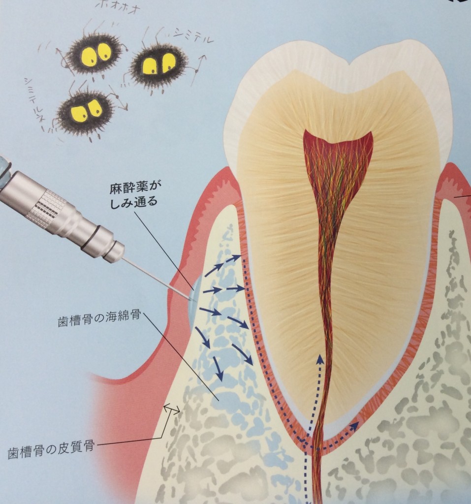 浸潤麻酔