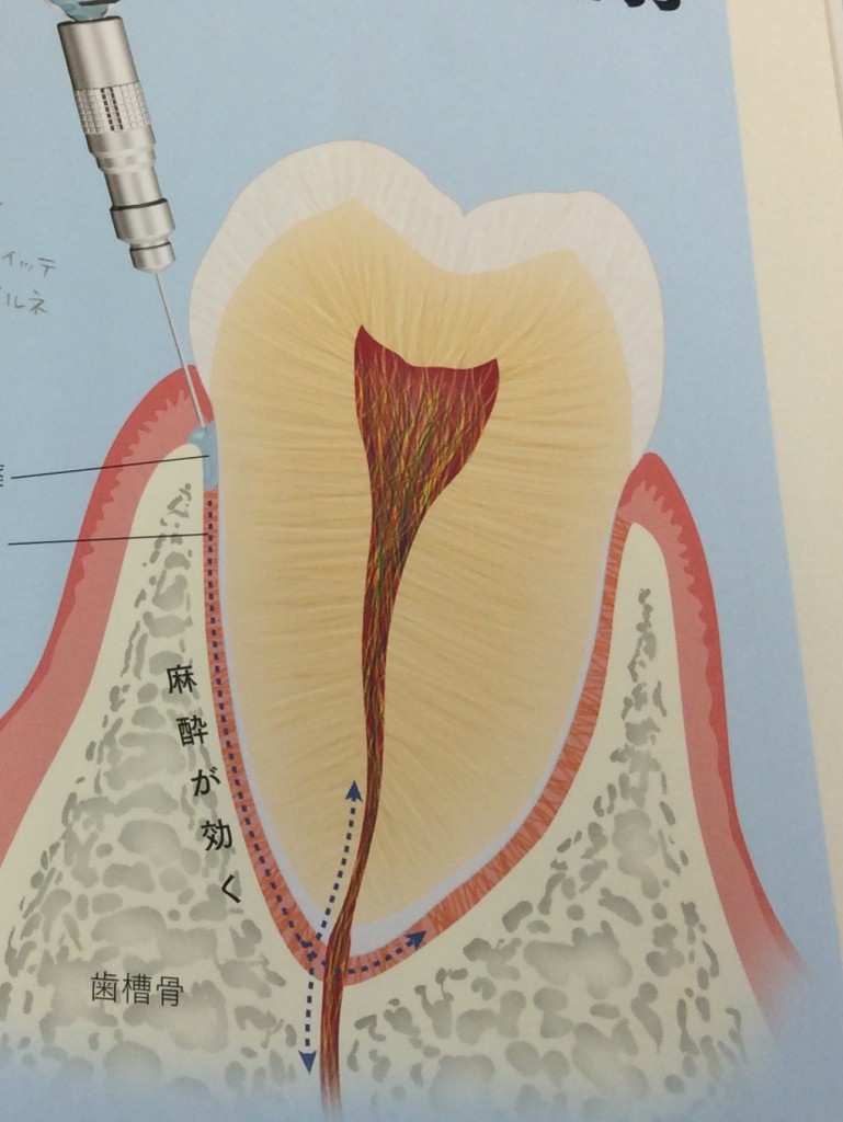 歯根膜注射